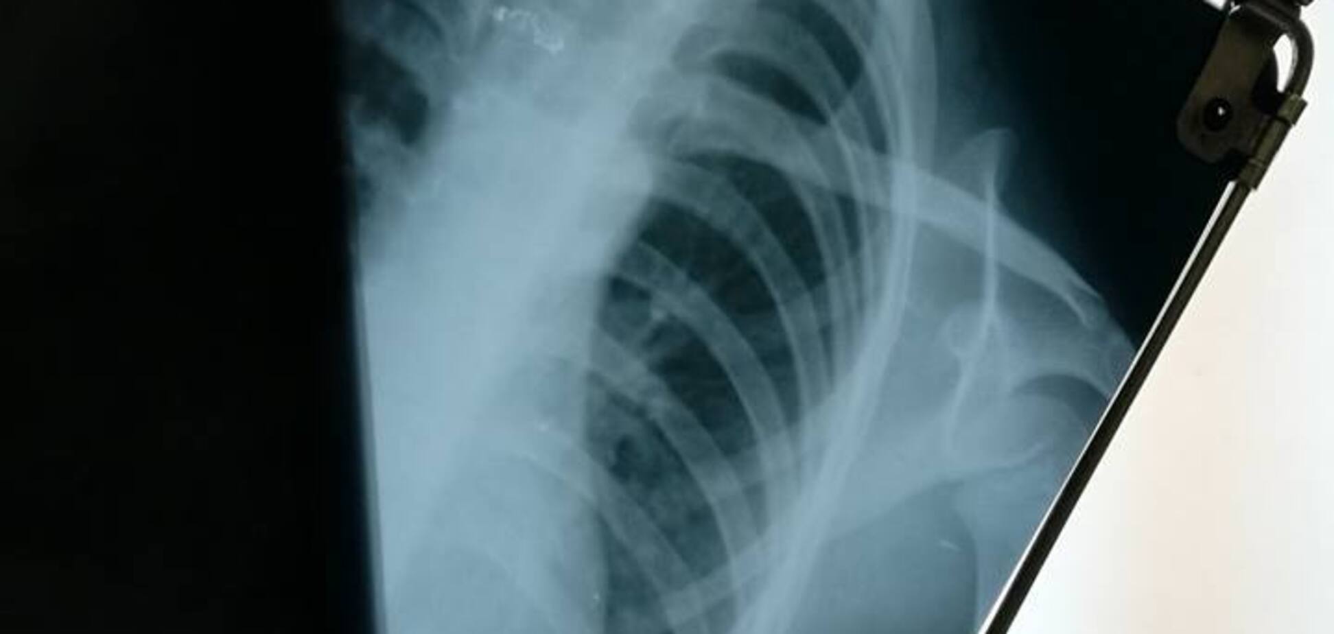 Из-за отказа сдать деньги? В детсаду Киева ребенка накормили супом с проволокой