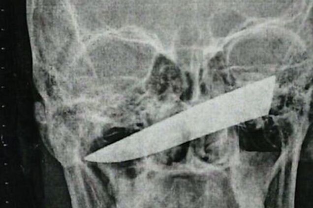 Залишився живий: африканець проходив із лезом ножа в оці 4 дні