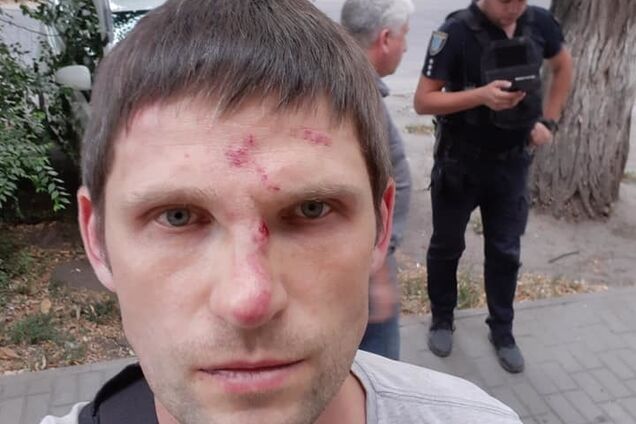 ''Ти чого посміхаєшся?'' У Дніпрі ''тітушки'' побили відомого волонтера: фото наслідків