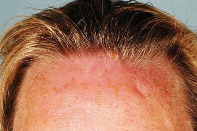 Вернулась с личинками в голове: женщина угодила в ЧП в отпуске