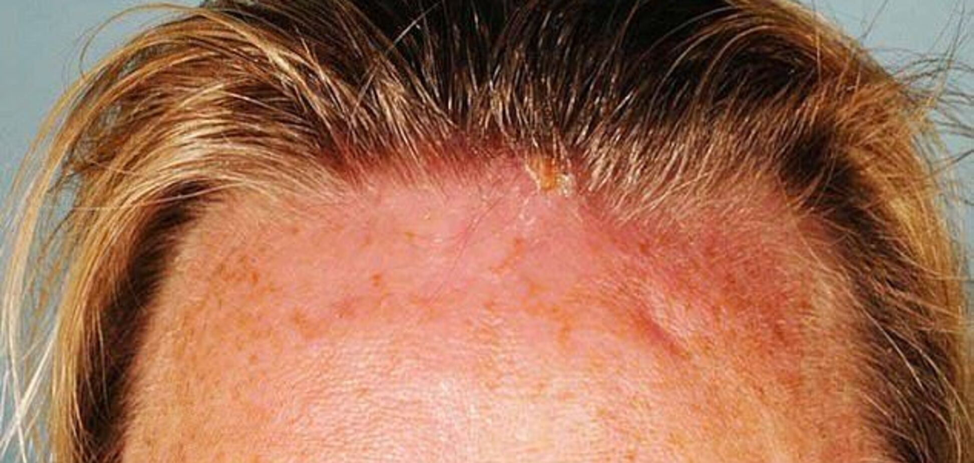 Вернулась с личинками в голове: женщина угодила в ЧП в отпуске