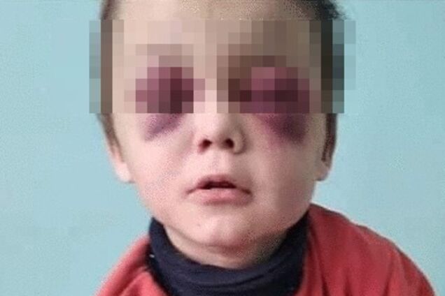 За синяками не видно глаз: на Винничине нашли жестоко избитого маленького ребенка. Фото 18+