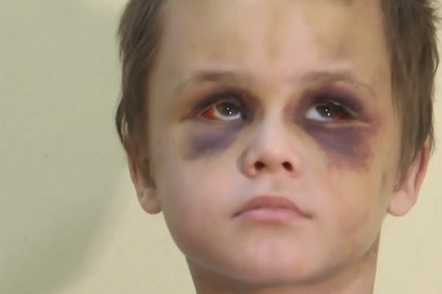 Обличчя синє, очей не видно: батьки пояснили звіряче побиття дитини