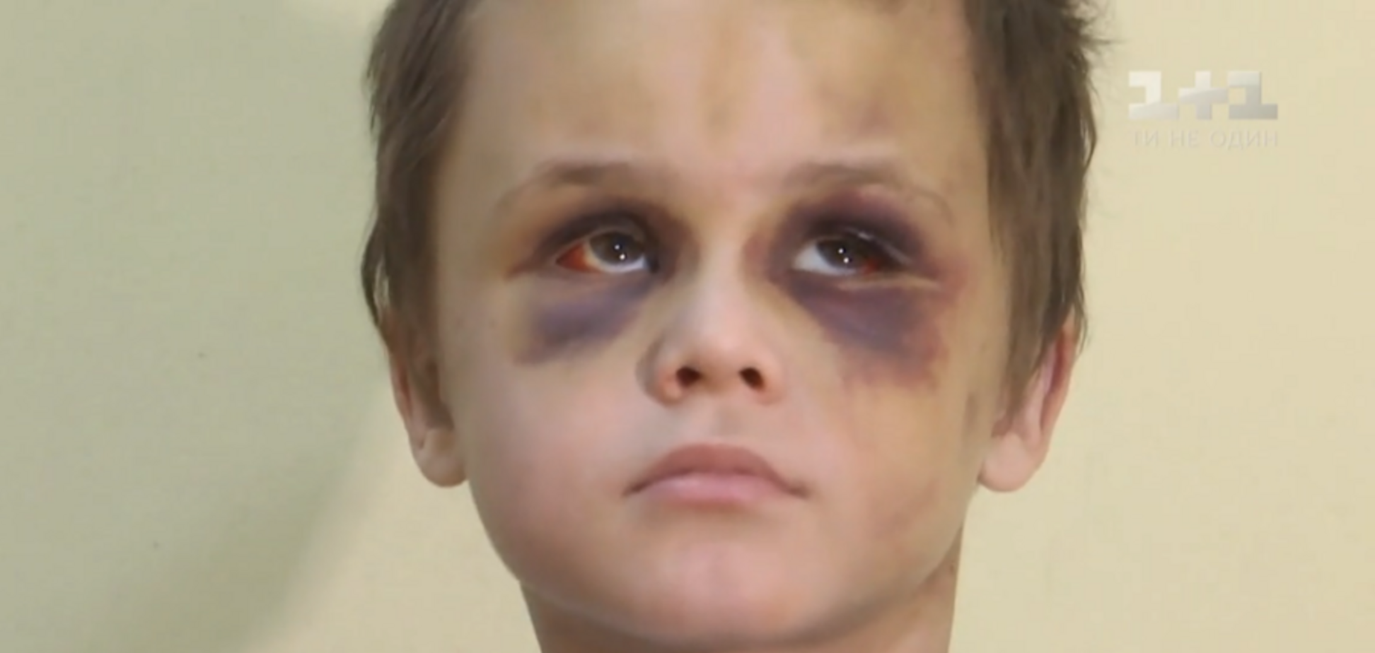 Лицо синее, глаз не видно: родители объяснили зверское избиение ребенка
