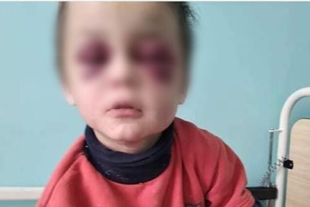 Под Винницей зверски избили 6-летнего малыша: горе-мачеха загадочно исчезла
