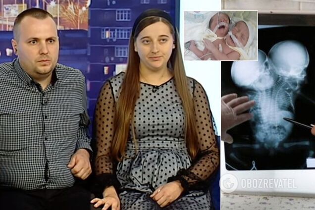 Родители сиамских близнецов из Черновцов показали первое фото детей