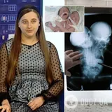 Родители сиамских близнецов из Черновцов показали первое фото детей