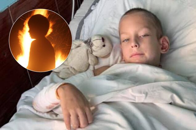 У Дніпрі підпалили хлопчика: з'явилися нові подробиці і фото 18+