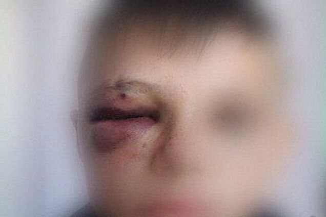 Око заплило: у Кривому Розі батько школяра по-звірячому побив його 'кривдника'. Фото 18+