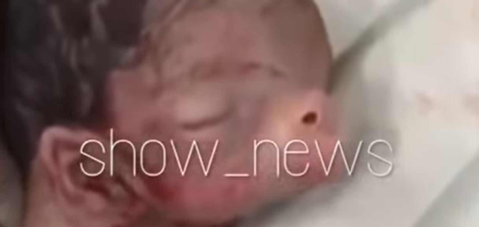 Дитина з вухами на шиї і свинячим п'ятаком народилася в Азербайджані: відео 18+