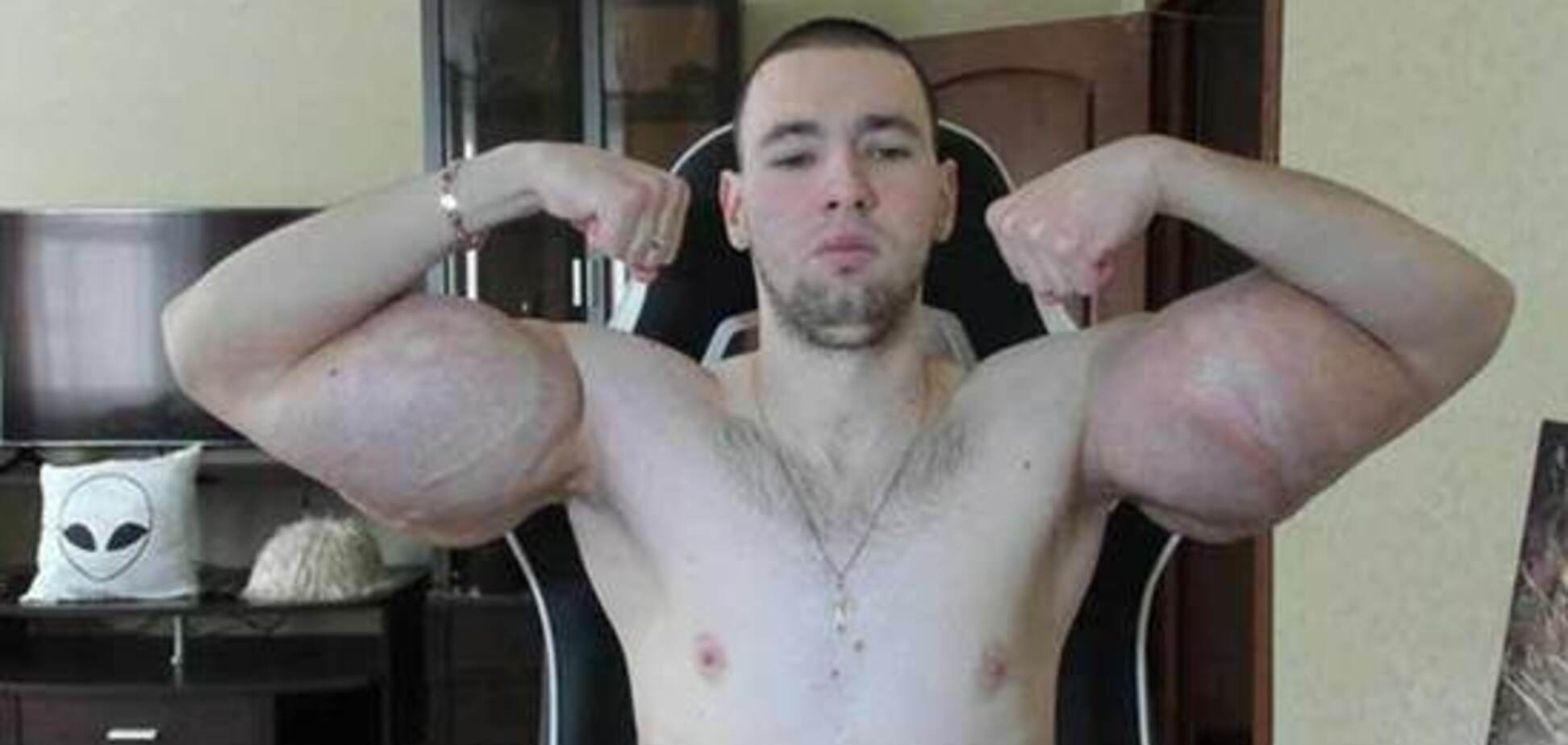 'Руки-базуки' показал сдувшиеся руки после операции: видео