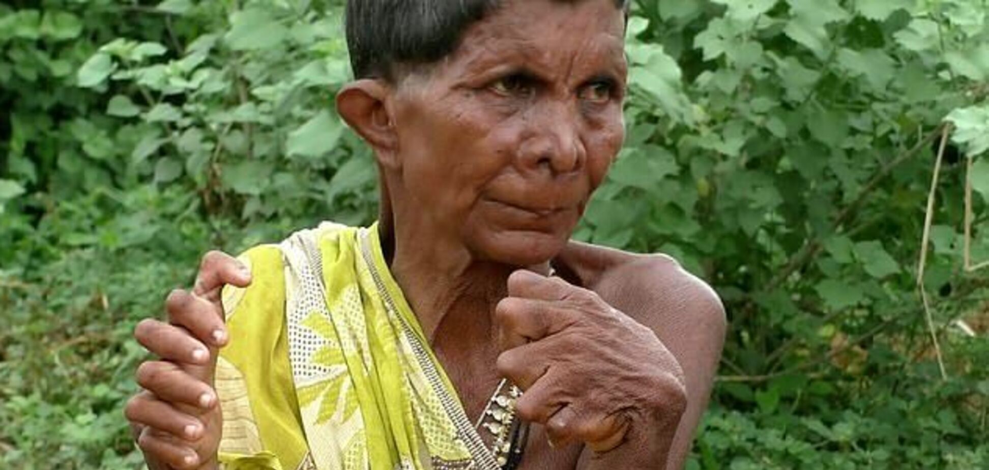 В Индии женщину с 31 пальцем приняли за ведьму. Фото