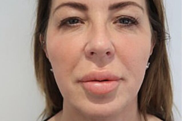 Шотландке сделали неудачную операцию по увеличению губ: шокирующее фото