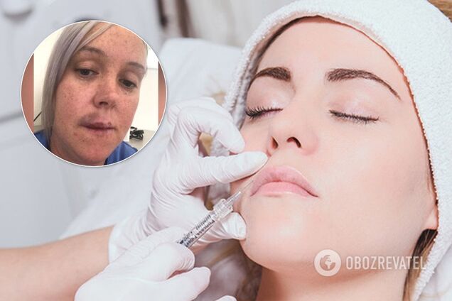 Як м'яч для гольфу: невдалий ботокс ледь не позбавив жінку частини обличчя