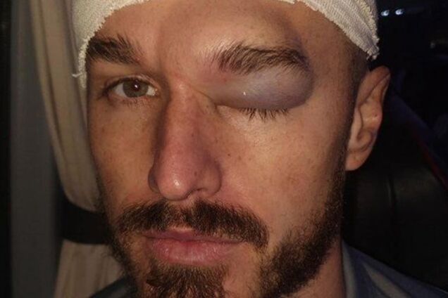 Жахлива гематома: футболіст ледь не втратив око під час матчу