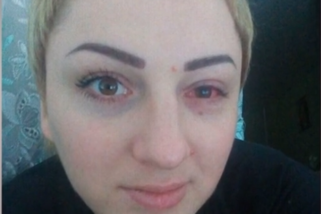 Эрозия и химический ожог: украинка ослепла на один глаз после косметический процедуры