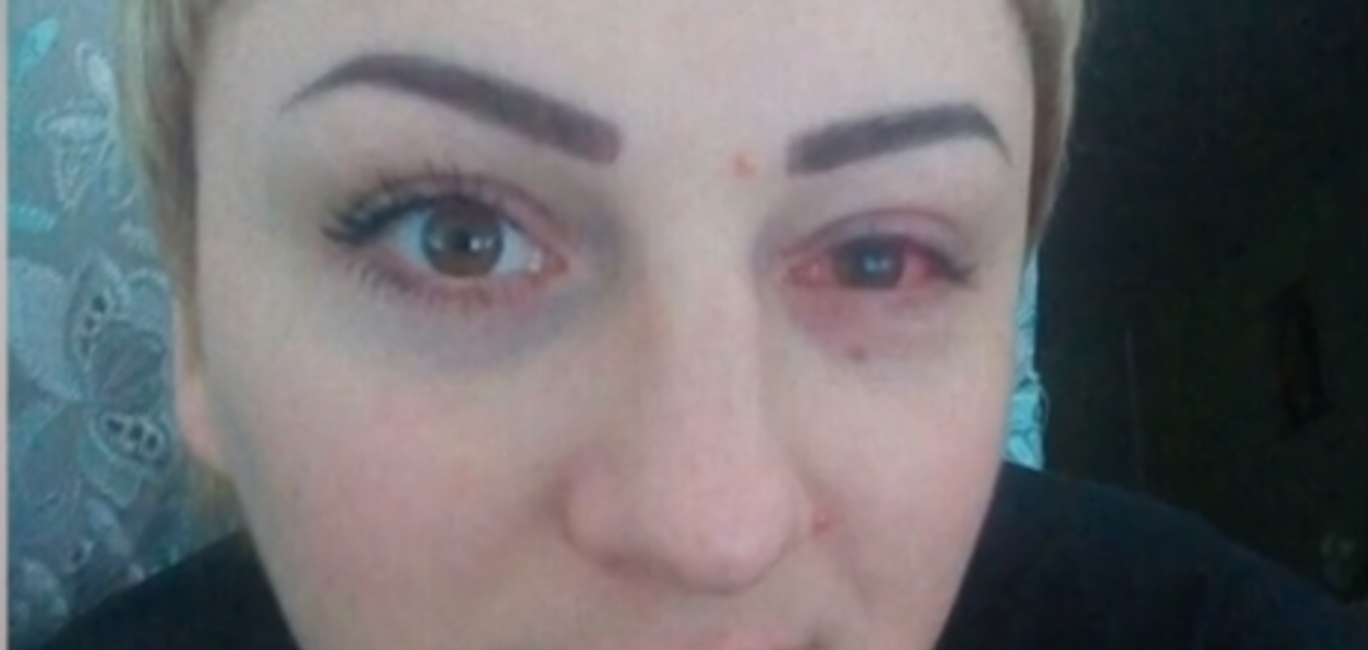  Эрозия и химический ожог: украинка ослепла на один глаз после косметический процедуры