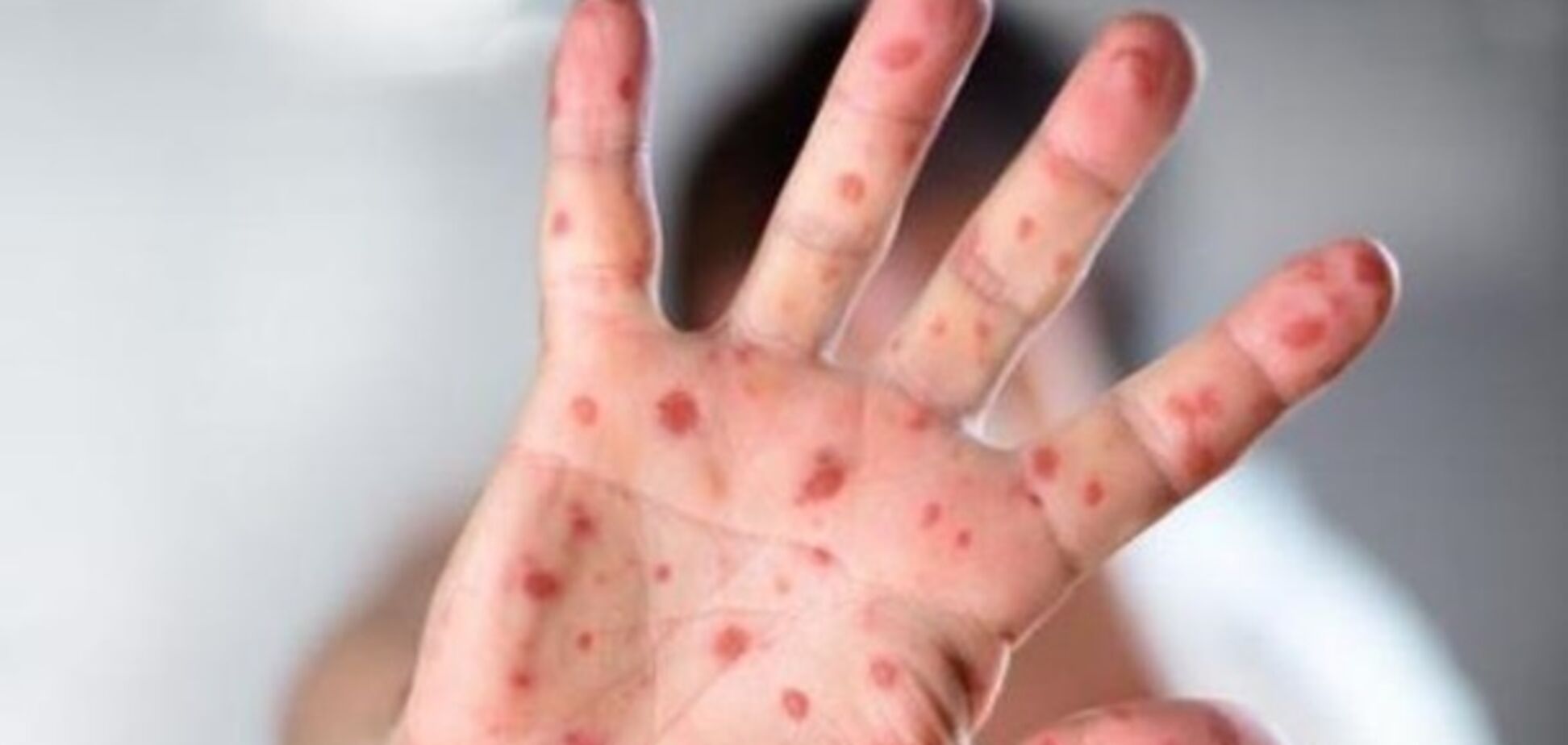 В Киеве от смертельной инфекции умерла женщина: что известно