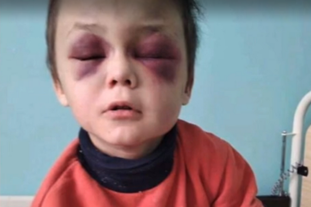 Очі чорні від побоїв: розкрилася страшна правда про побиття 6-річної дитини на Вінничині