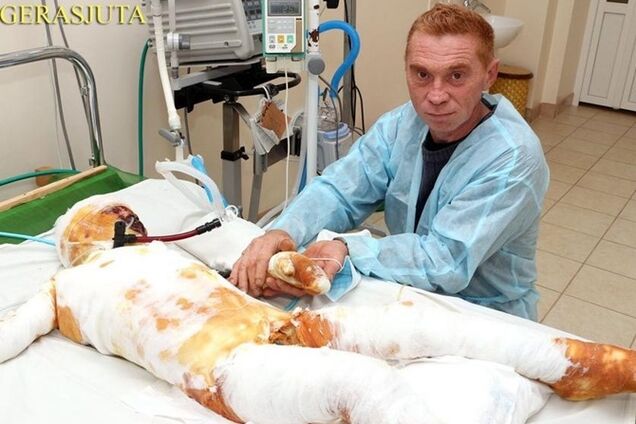 Выжил после удара тока в 27 тысяч вольт: на Николаевщине родители бросили в больнице обожженного сына