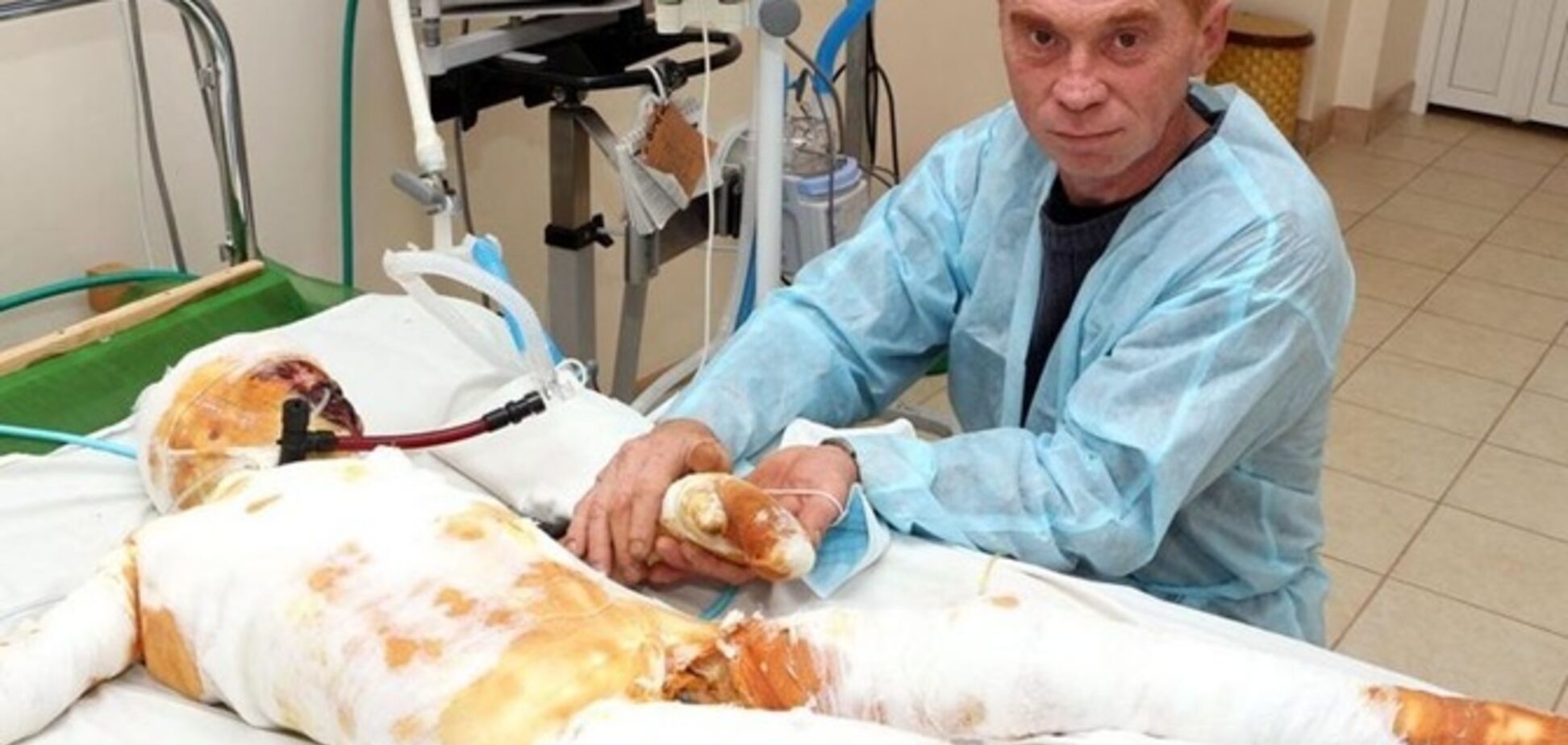 Выжил после удара тока в 27 тысяч вольт: на Николаевщине родители бросили в больнице обожженного сына