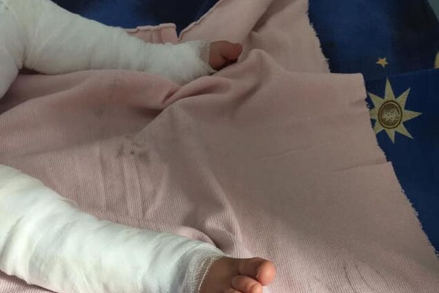 'Страшні муки, дивитися нестерпно': на Одещині малюк 'зварився' в окропі. Шокуючі фото і відео 18+