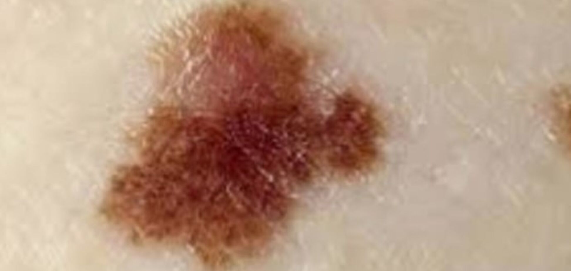 Як відрізнити родимки та веснянки від раку шкіри: названі головні ознаки