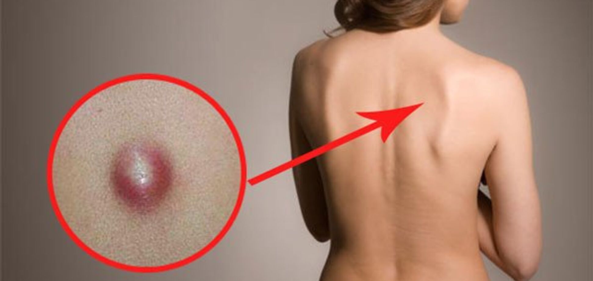 Что такое - липома?