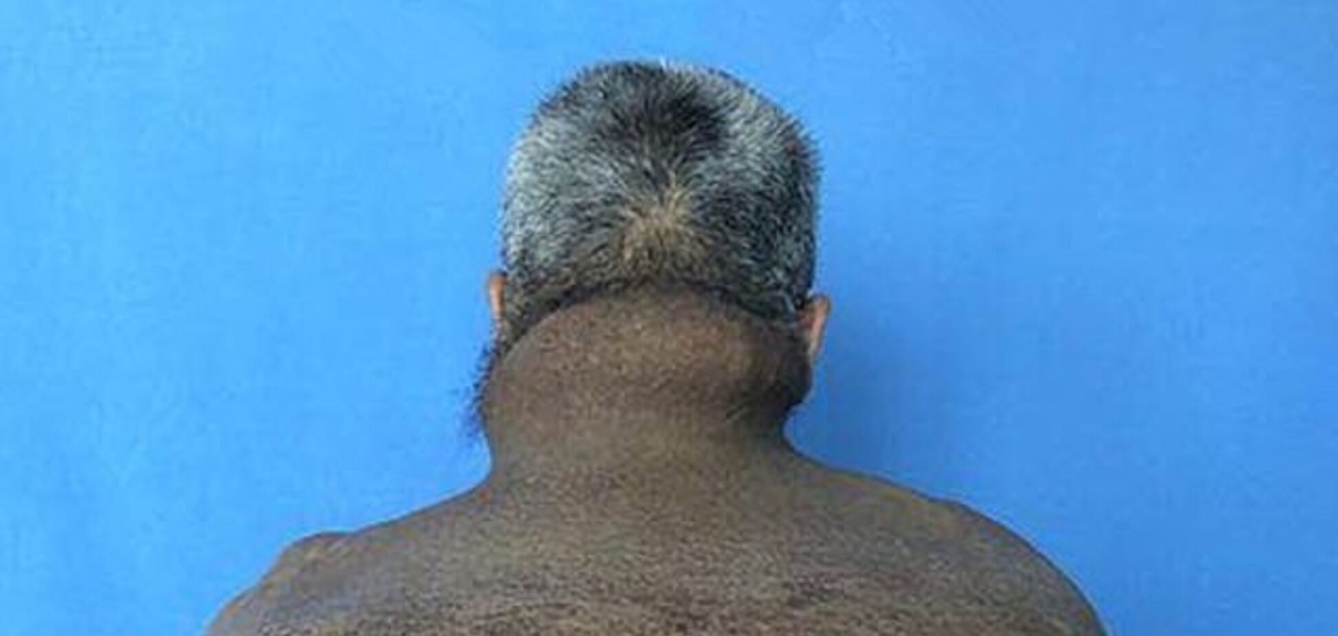 Китаєць 30 років ростив 15-кілограмову пухлину: фото 18+