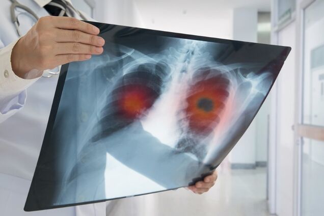 Вчені сказали, як уберегтися від раку легенів