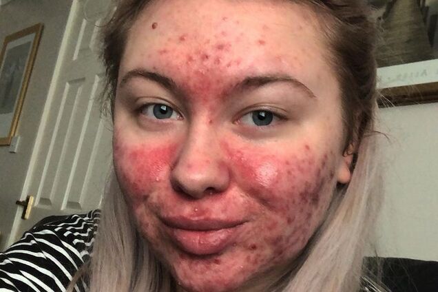 Страждаюча від прищів студентка позбулася комплексу і завела Instagram
