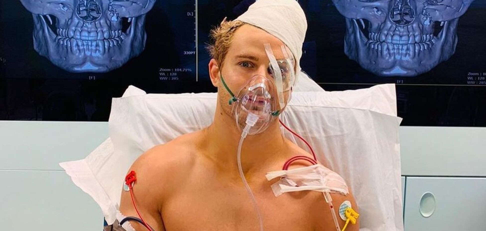 Бойцу ММА сломали лицо в 8 местах в дебютном бою