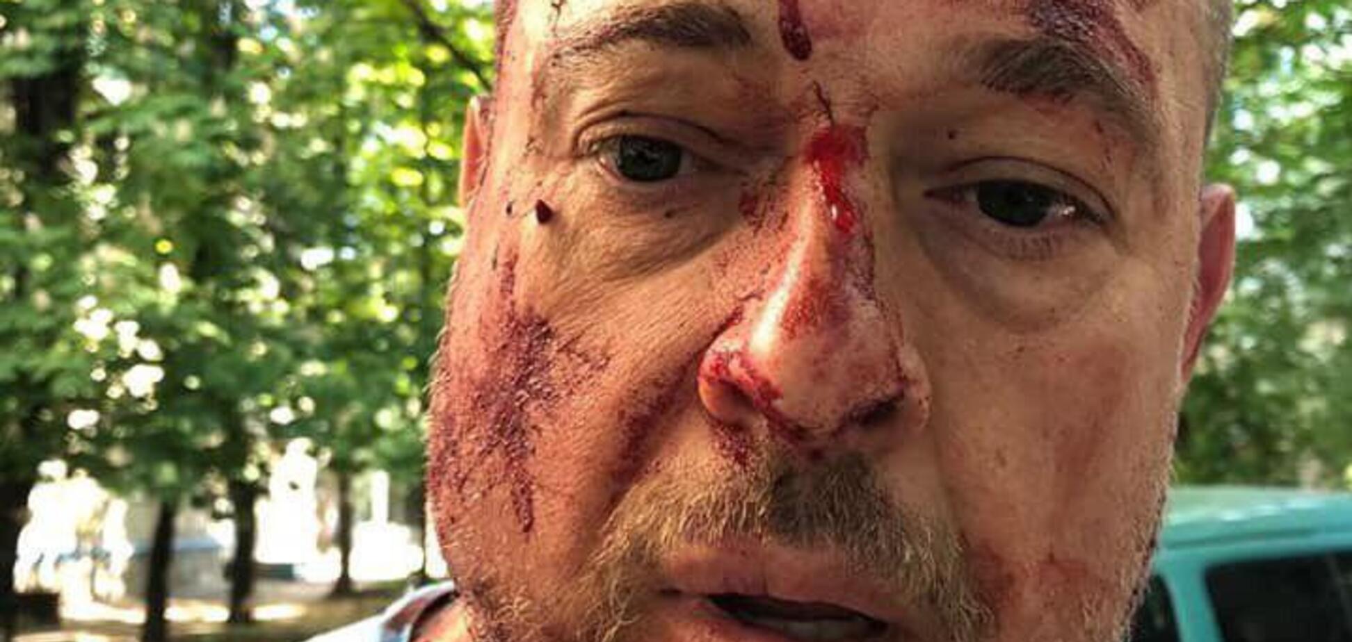 Били кастетами по голове: в Харькове совершено жестокое нападение на активиста. Фото и видео 18+