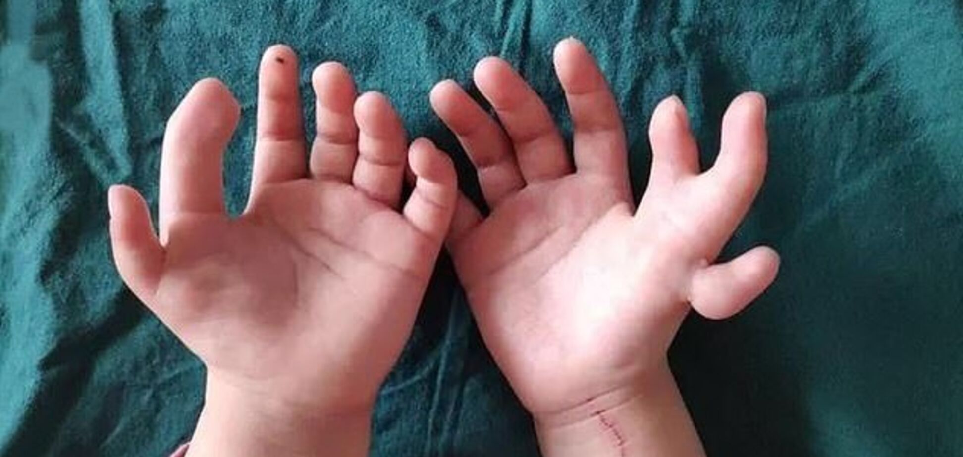 Было намного больше 10: в Китае девочке отрезали лишние пальцы на руках. Жуткие фото