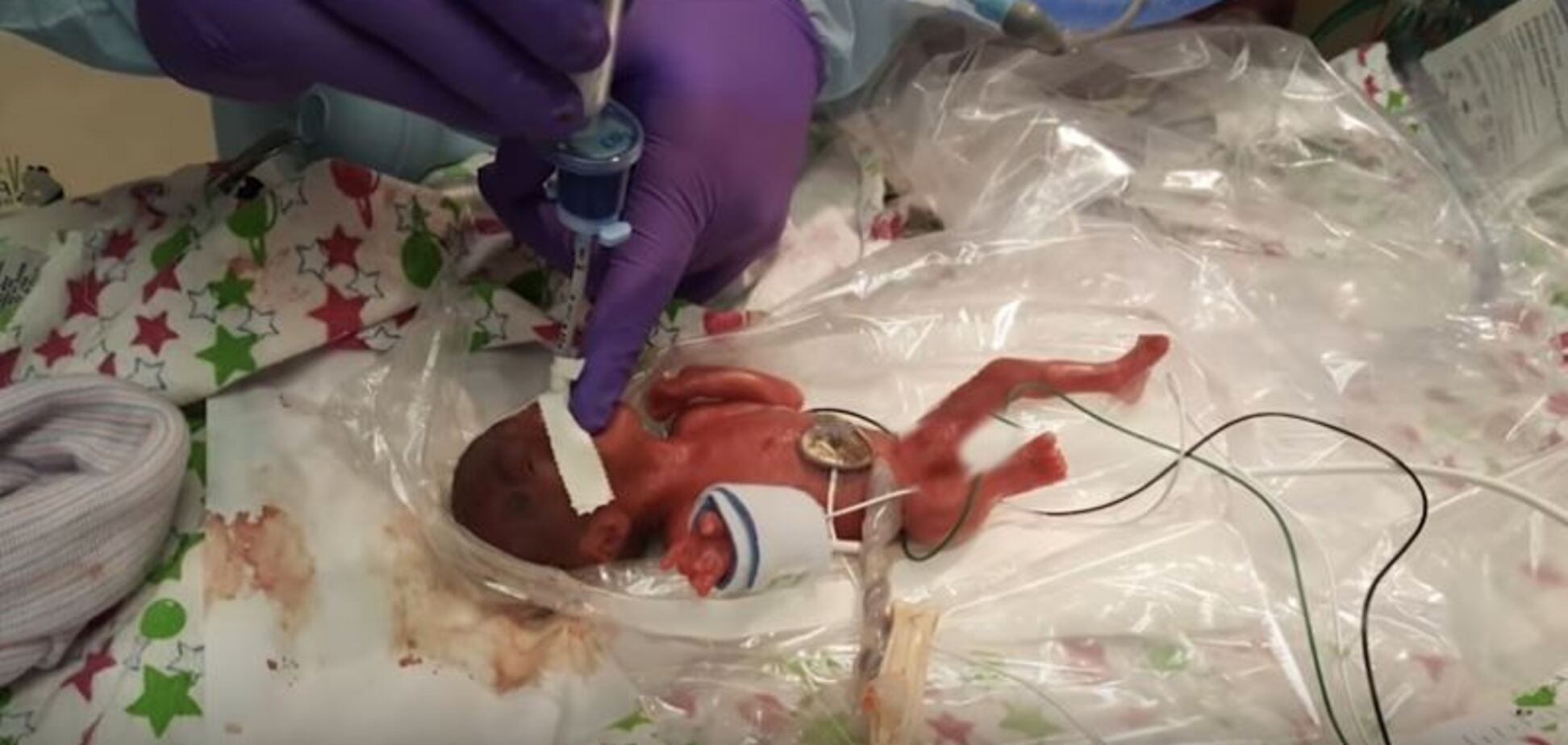 Самый крошечный в мире новорожденный чудом выжил