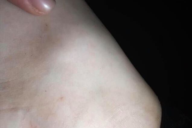 Под Киевом девушку во время купания укусила змея