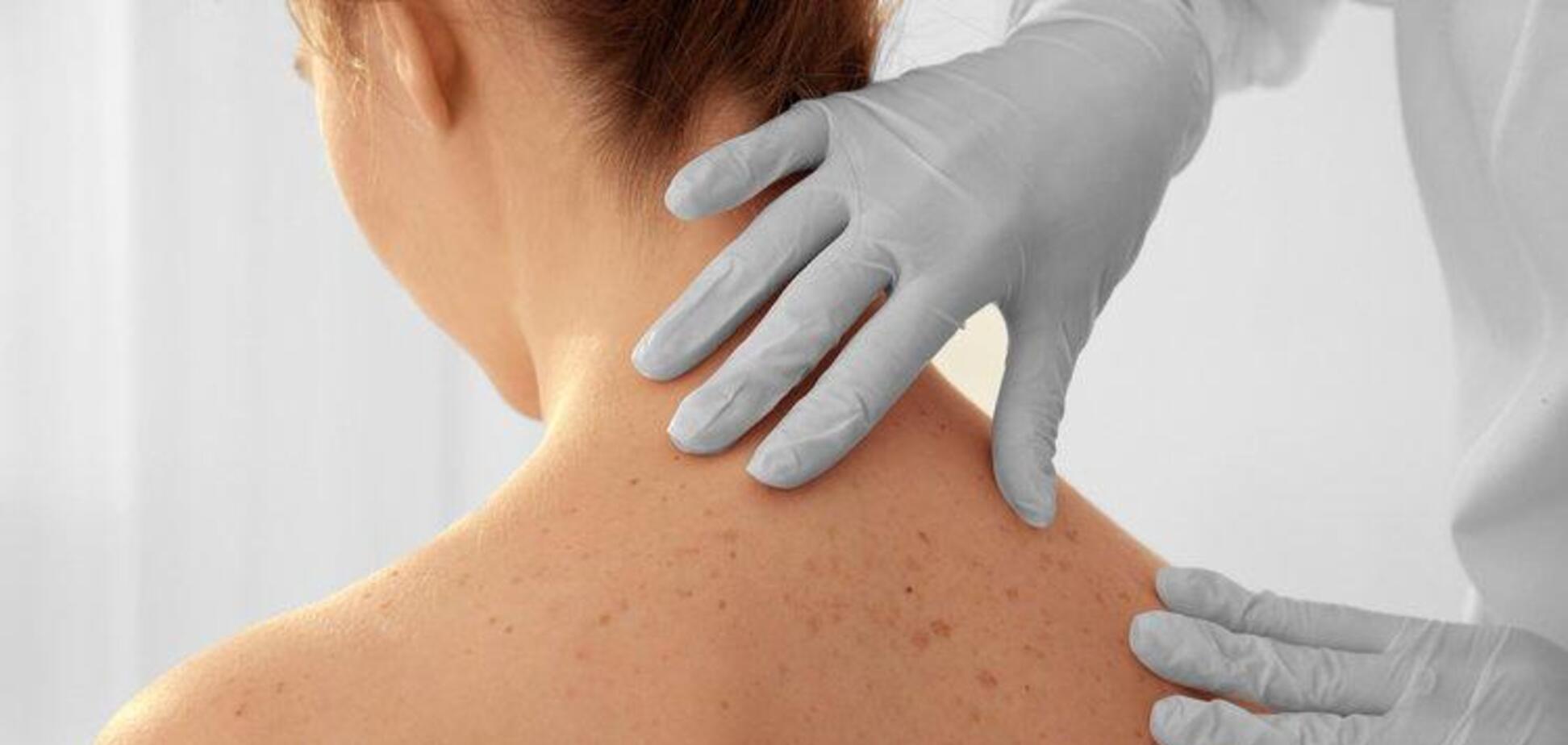Ученые нашли новые причины появления рака кожи