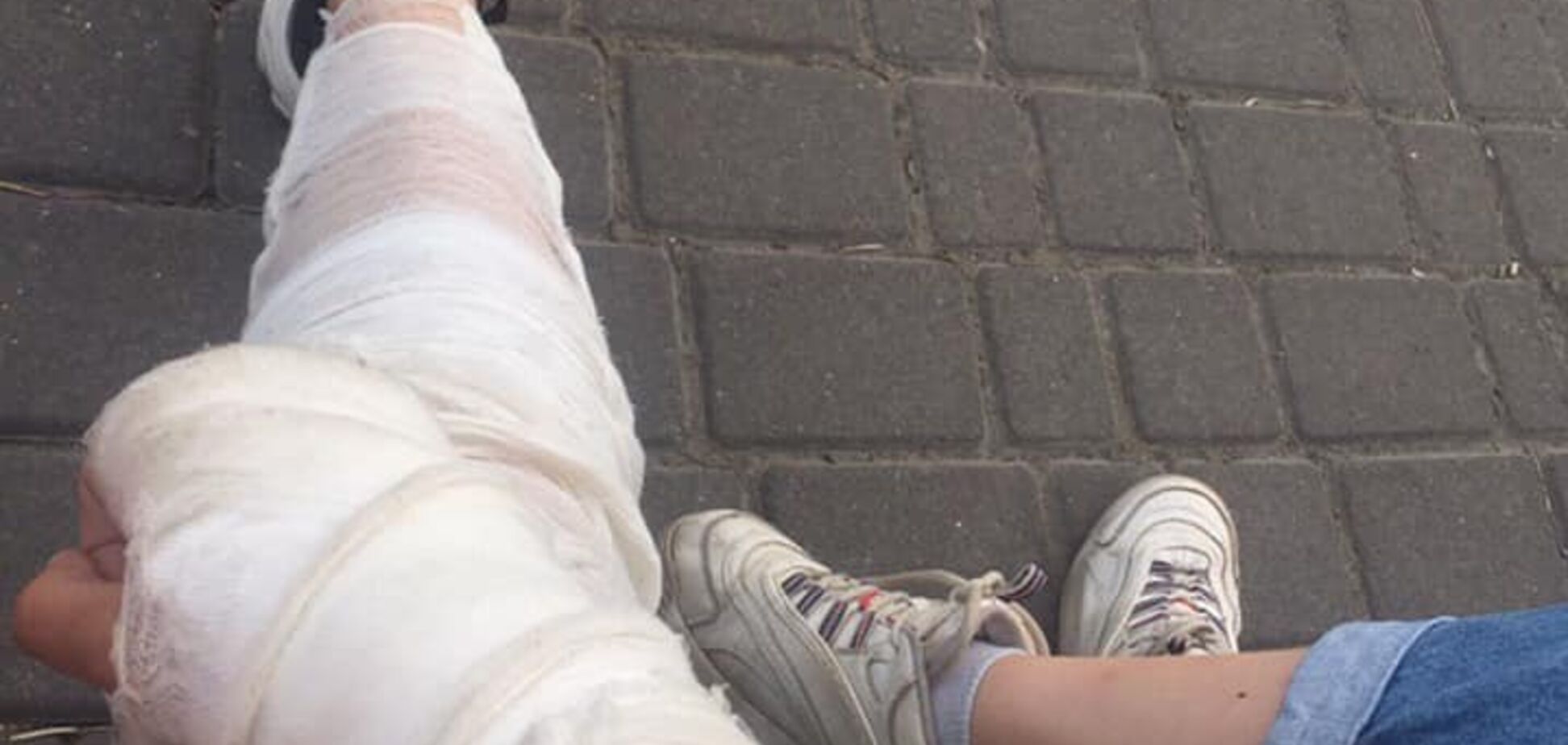 Рука и нога в гипсе