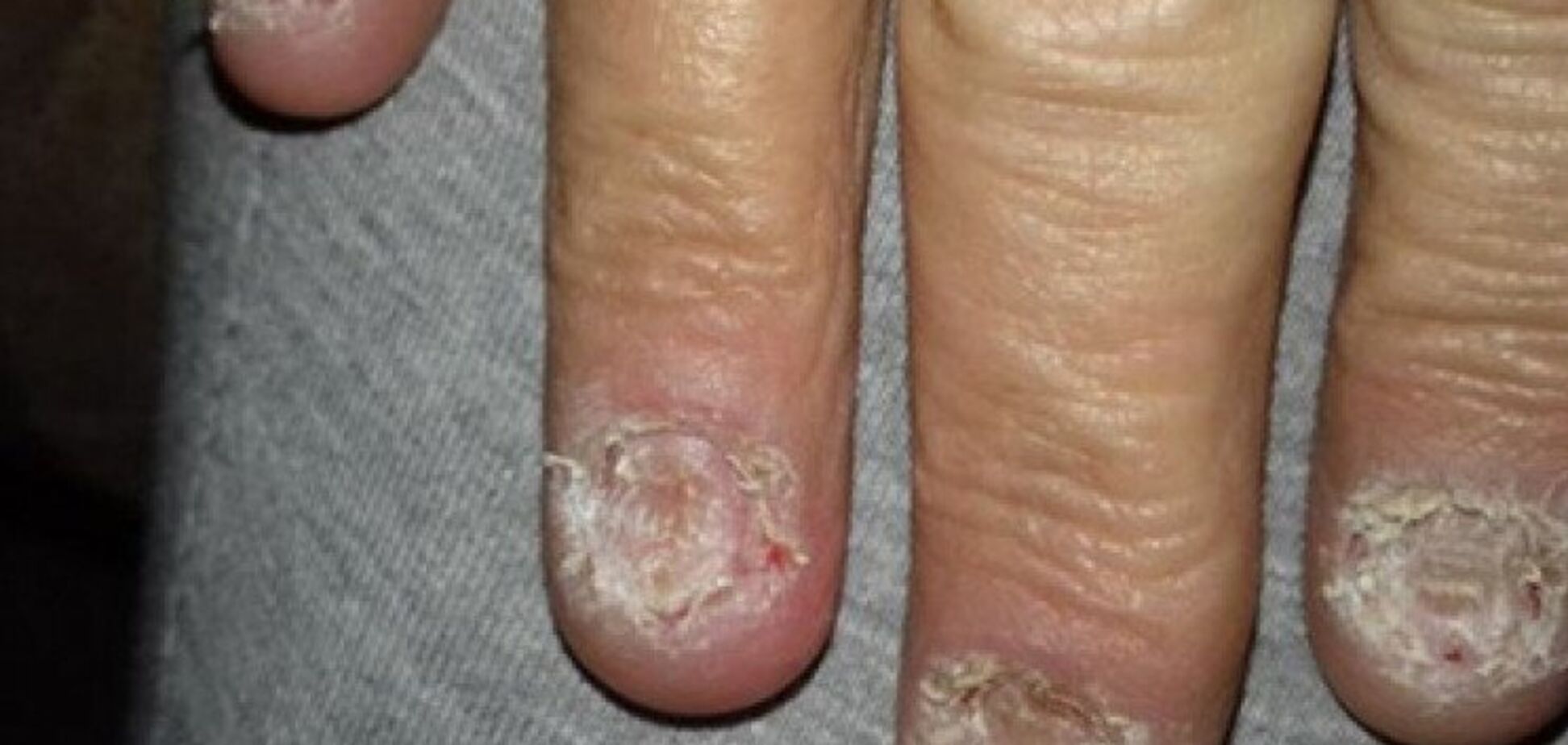 Гноят и кровоточат: загадочная болезнь уничтожила все ногти женщины