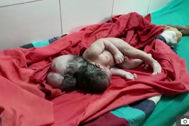 В Індії народилася дівчинка з трьома головами: моторошні фото і відео 18+
