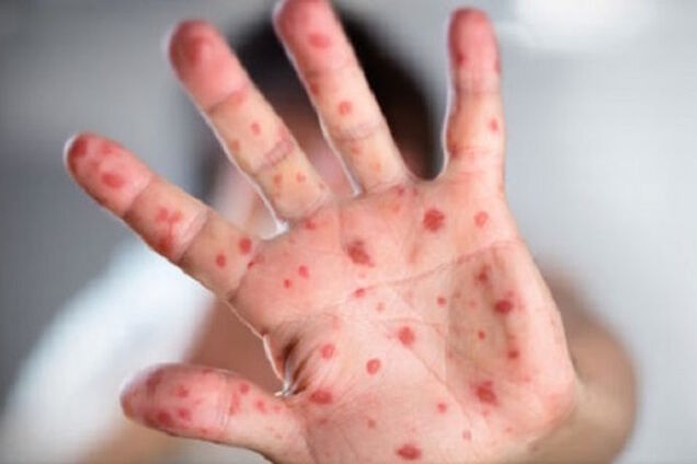 Нету вакцинации от кори – не студенты: в вузах Тернополя подготовили нововведения