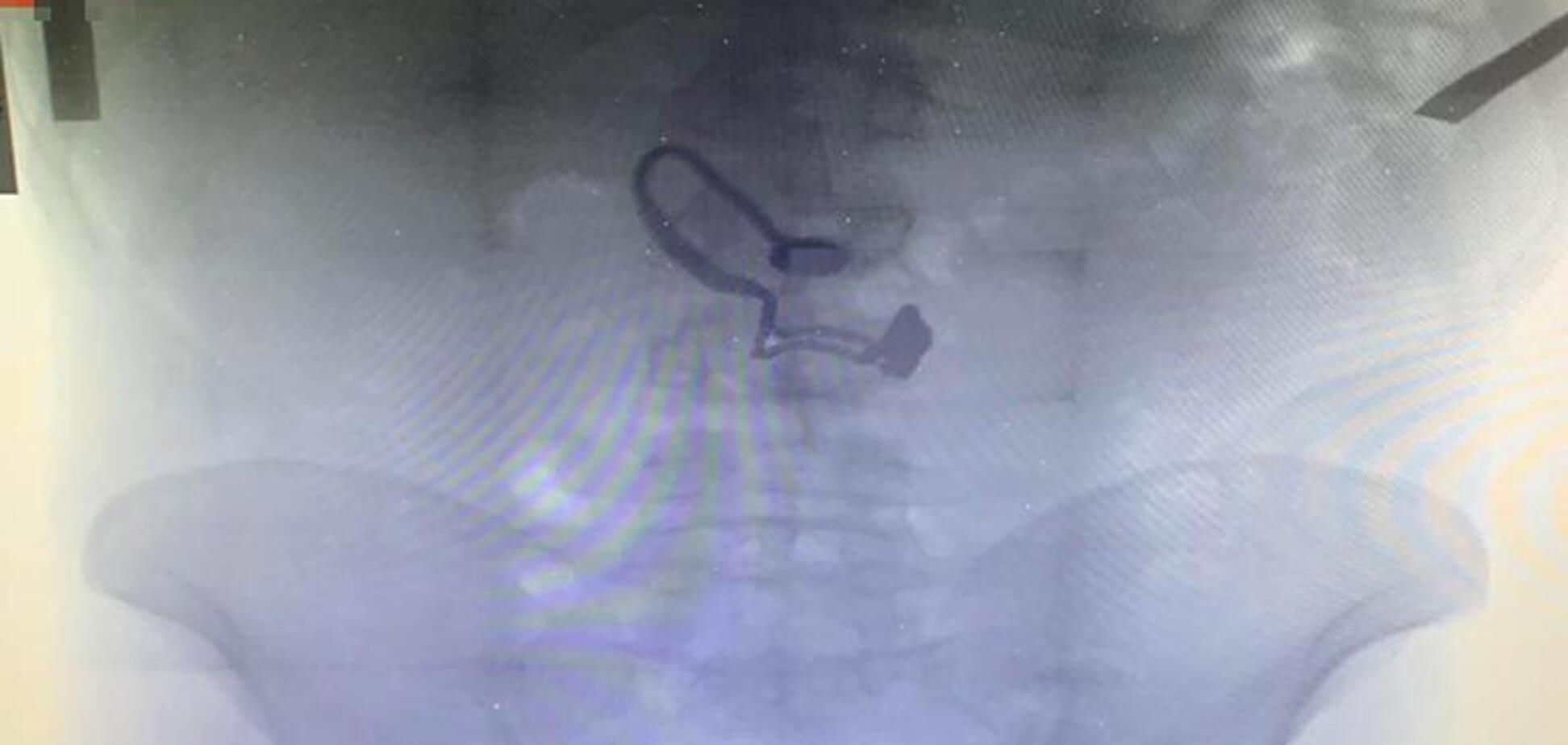 В Киеве грабитель съел золотую цепочку пострадавшей