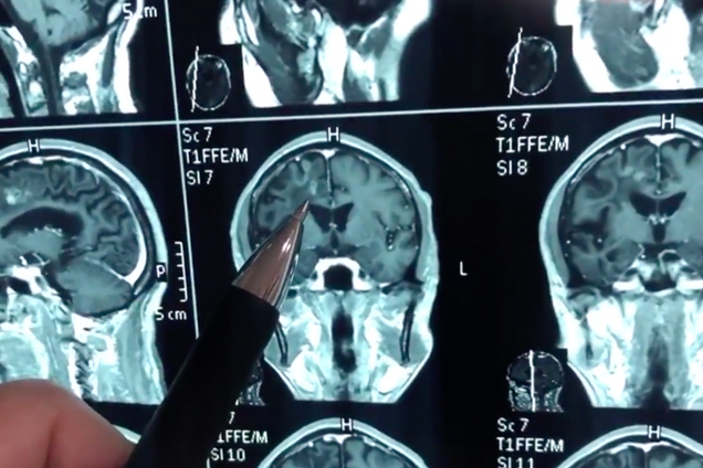 Страждав 30 років: у чоловіка витягли величезного хробака з голови