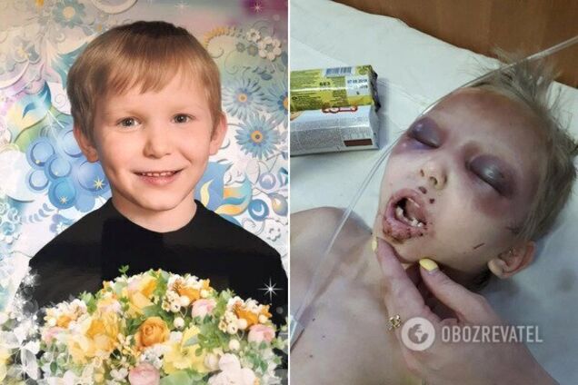 Колола голкою і забороняла плакати: історія зі звірячим побиттям дитини отримала несподіваний поворот