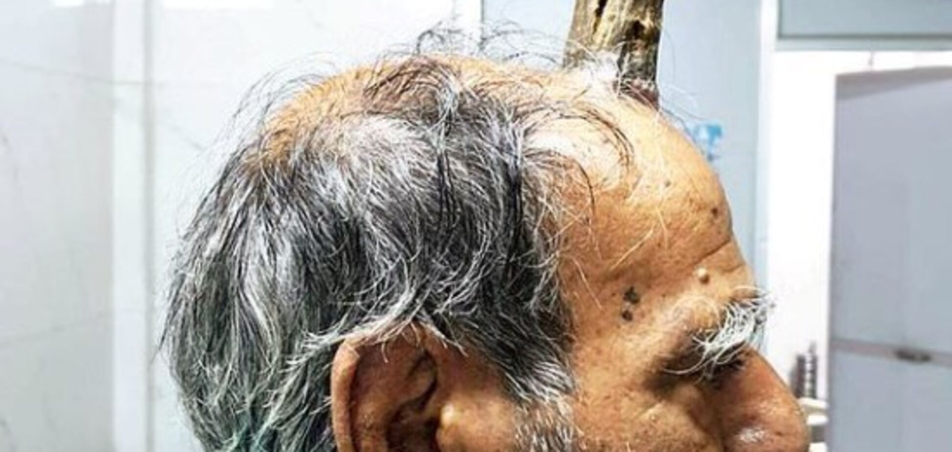 В Індії у чоловіка 5 років ріс 'диявольський ріг': фото