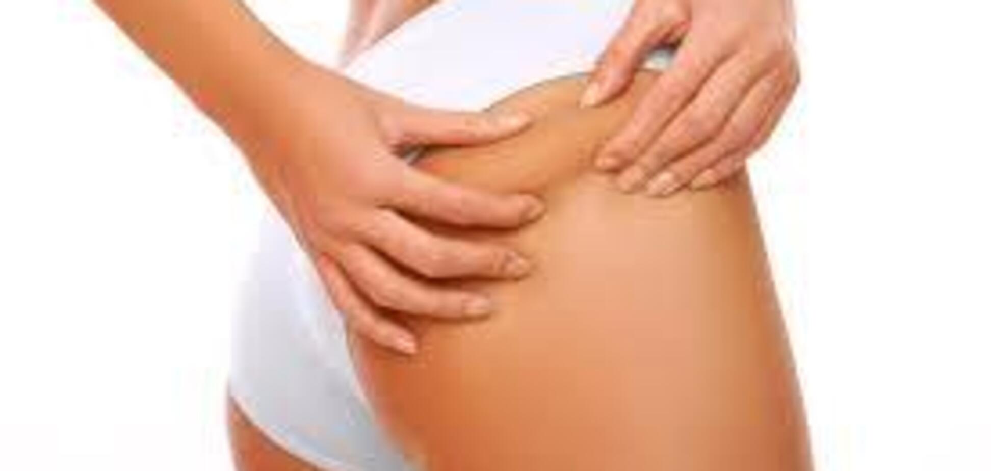 Как избавиться от растяжек: диетолог раскрыла секрет