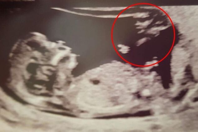 У Британії жінка, яка дивом завагітніла, побачила на знімку УЗД "янгола-охоронця"