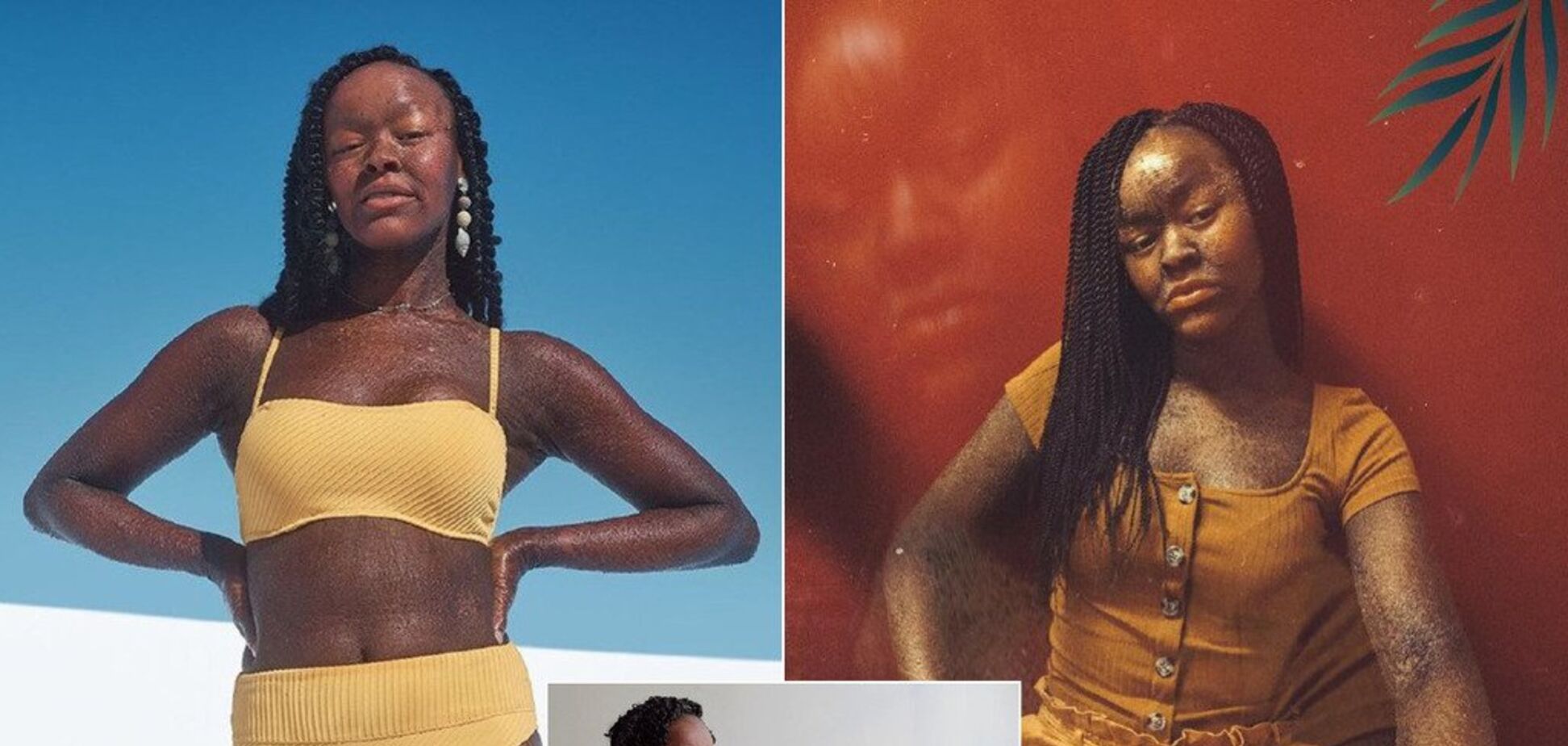 Чешуя вместо кожи: модель с редким заболеванием снялась в рекламе купальников