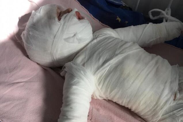 Годовалый ребенок ошпарился кипятком на Одесщине