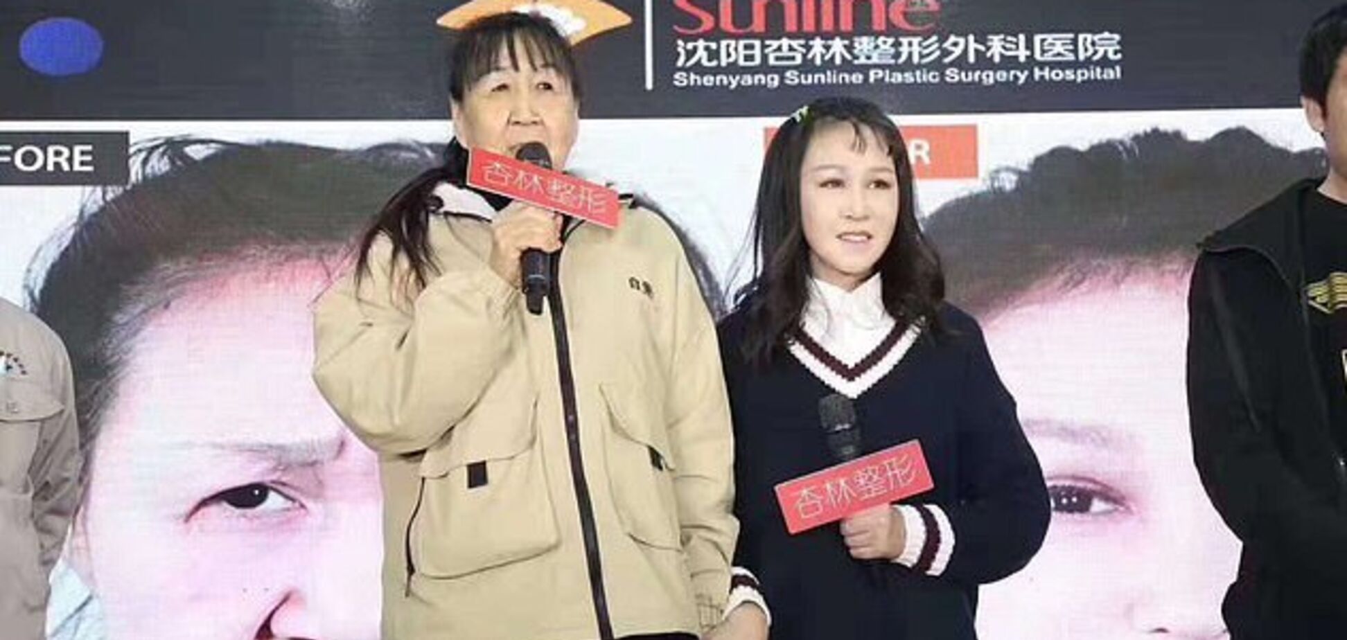 15-летней девочке с лицом 'бабушки' сделали пластическую операцию: фото до и после